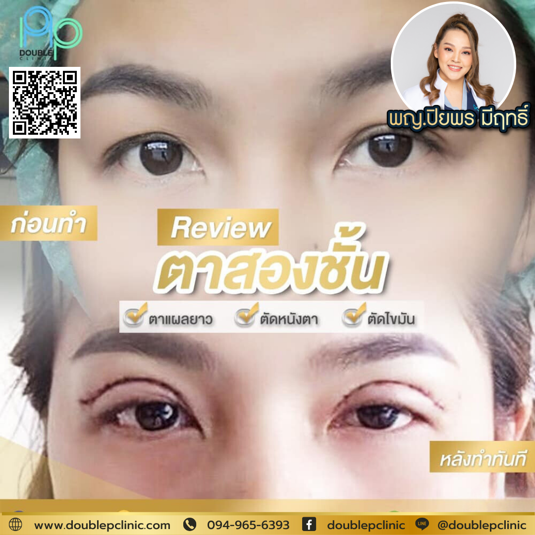หนังตาตกข้างเดียว เกิดจาก หนังตาตกข้างเดียว เกิดจาก