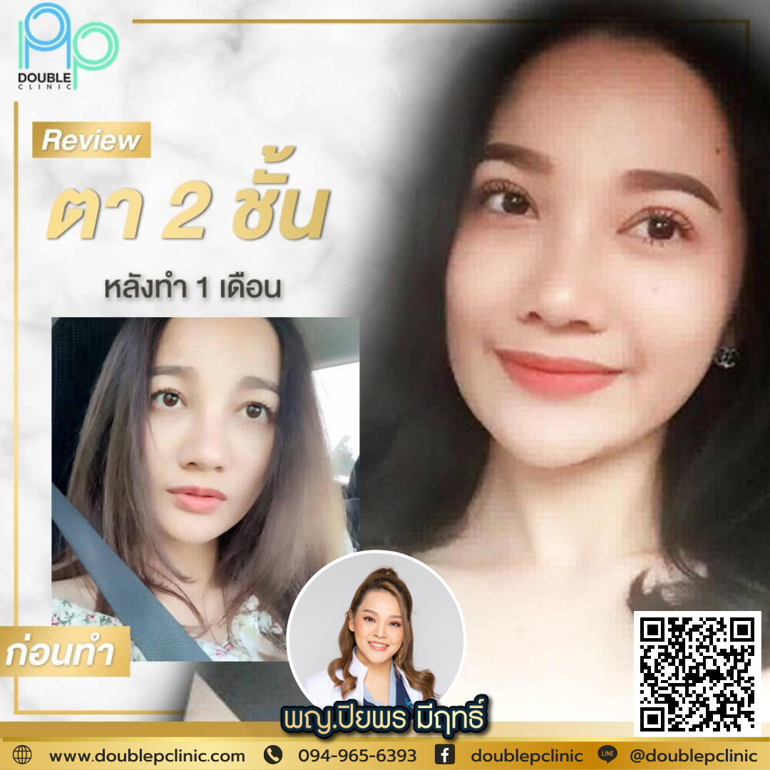 ตาชั้นเดียว เกิดจากอะไร ตาชั้นเดียว เกิดจากอะไร