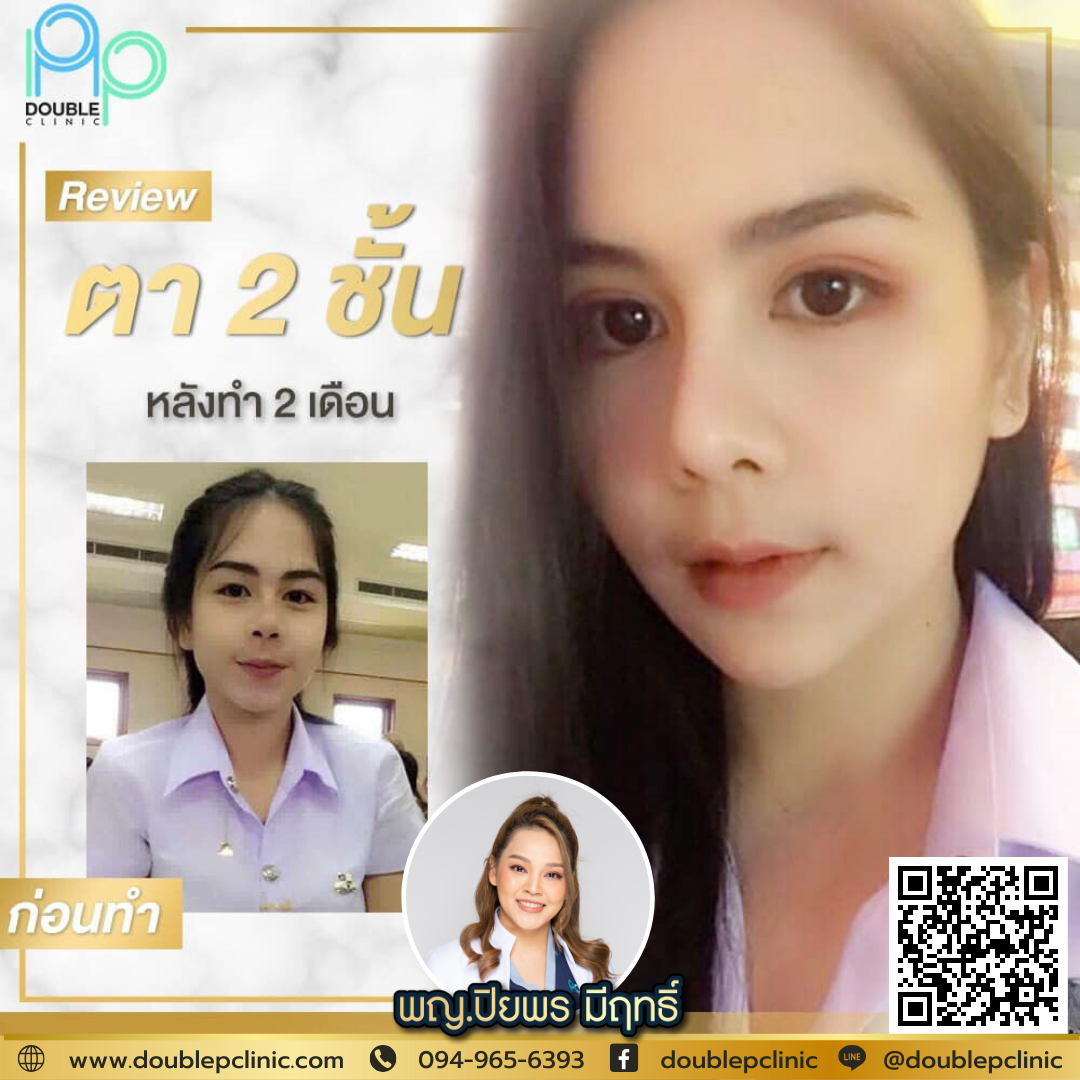 ตาชั้นเดียว เกิดจากอะไร ตาชั้นเดียว เกิดจากอะไร