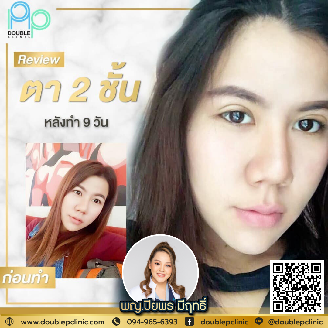 ตาชั้นเดียว เกิดจากอะไร ตาชั้นเดียว เกิดจากอะไร