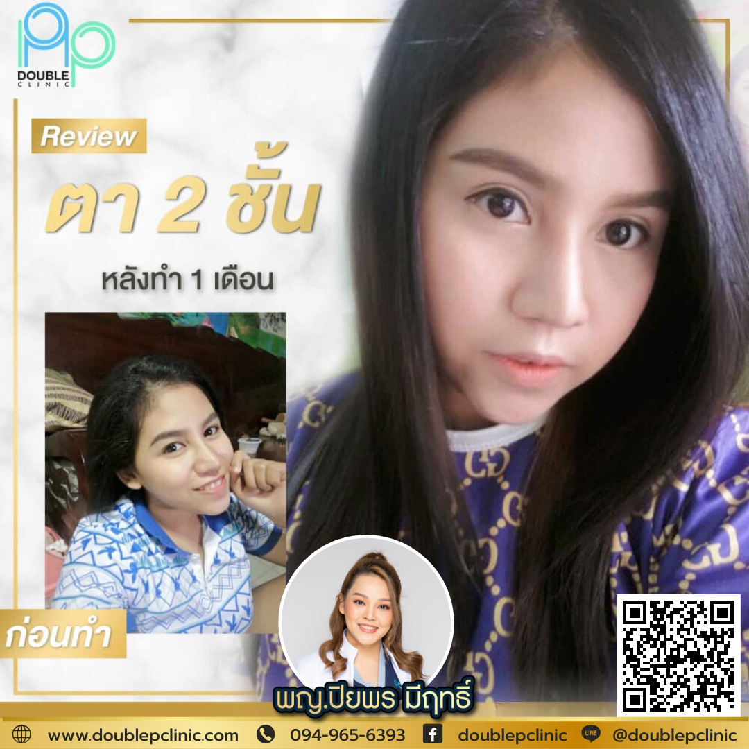 ตาชั้นเดียว เกิดจากอะไร ตาชั้นเดียว เกิดจากอะไร