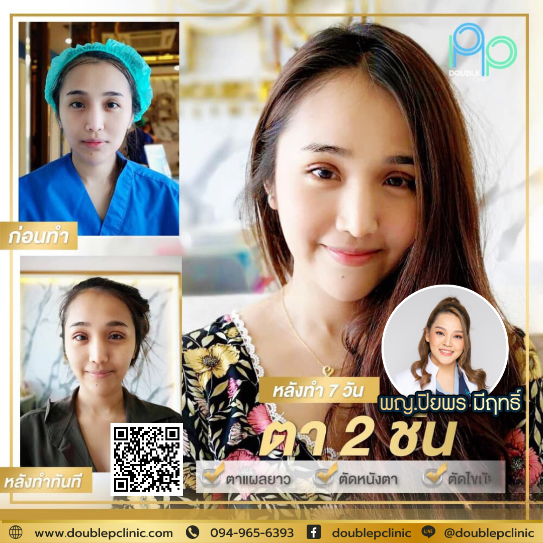 ตาสองชั้น กรีดยาว แผลเล็ก ตาสองชั้น กรีดยาว แผลเล็ก