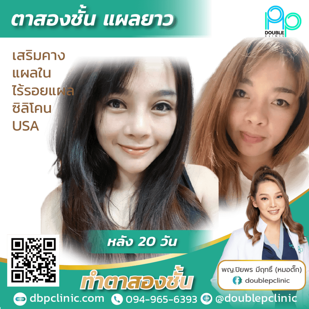ผ่าตัดกล้ามเนื้อตาอ่อนแรง เจ็บไหม ผ่าตัดกล้ามเนื้อตาอ่อนแรง เจ็บไหม