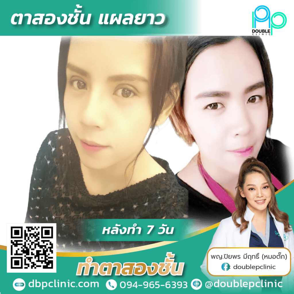 ผ่าตัดกล้ามเนื้อตาอ่อนแรง เจ็บไหม ผ่าตัดกล้ามเนื้อตาอ่อนแรง เจ็บไหม