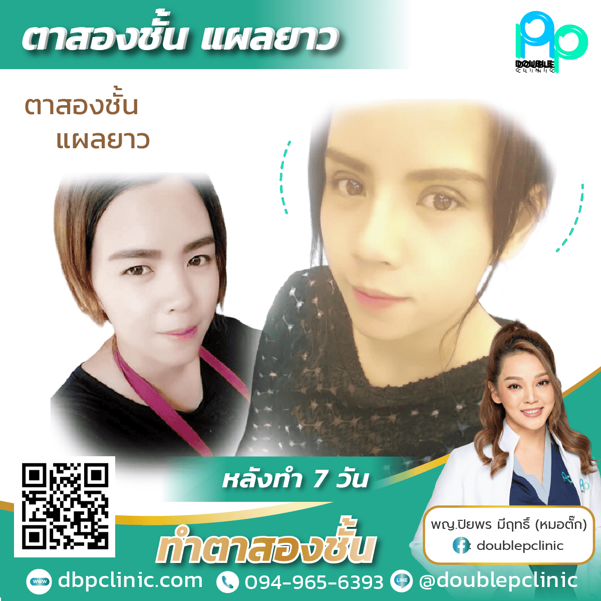 กล้ามเนื้อตาอ่อนแรง แก้ไขยังไง กล้ามเนื้อตาอ่อนแรง แก้ไขยังไง