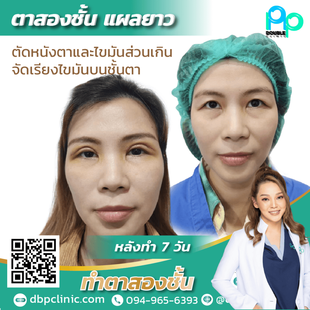 กล้ามเนื้อตาอ่อนแรง แก้ไขยังไง กล้ามเนื้อตาอ่อนแรง แก้ไขยังไง