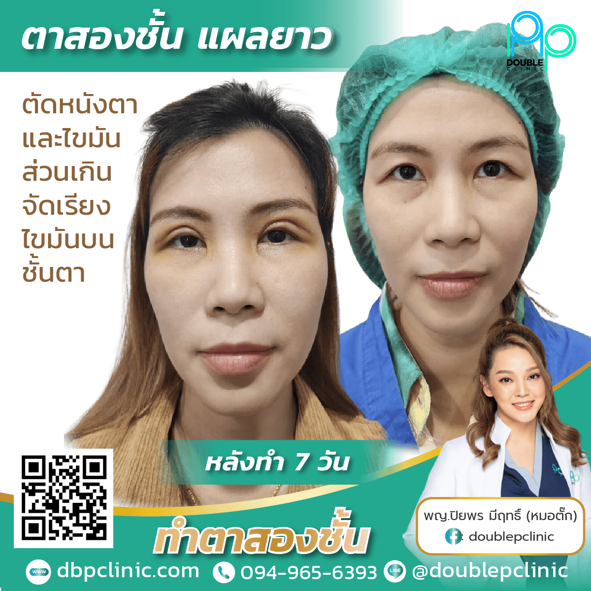 กล้ามเนื้อตาอ่อนแรง เกิดจากอะไร 