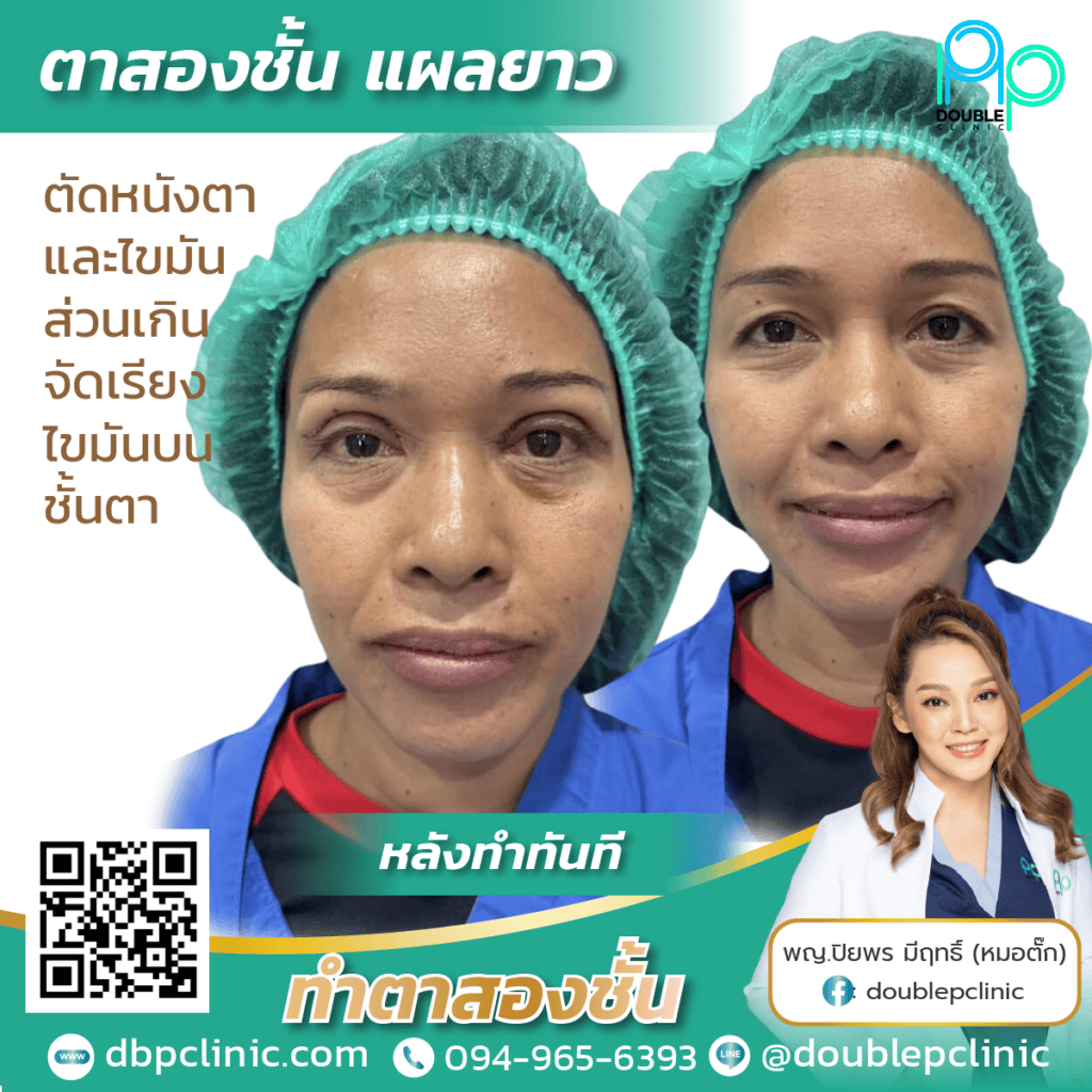 กล้ามเนื้อตาอ่อนแรง แก้ไขยังไง กล้ามเนื้อตาอ่อนแรง แก้ไขยังไง