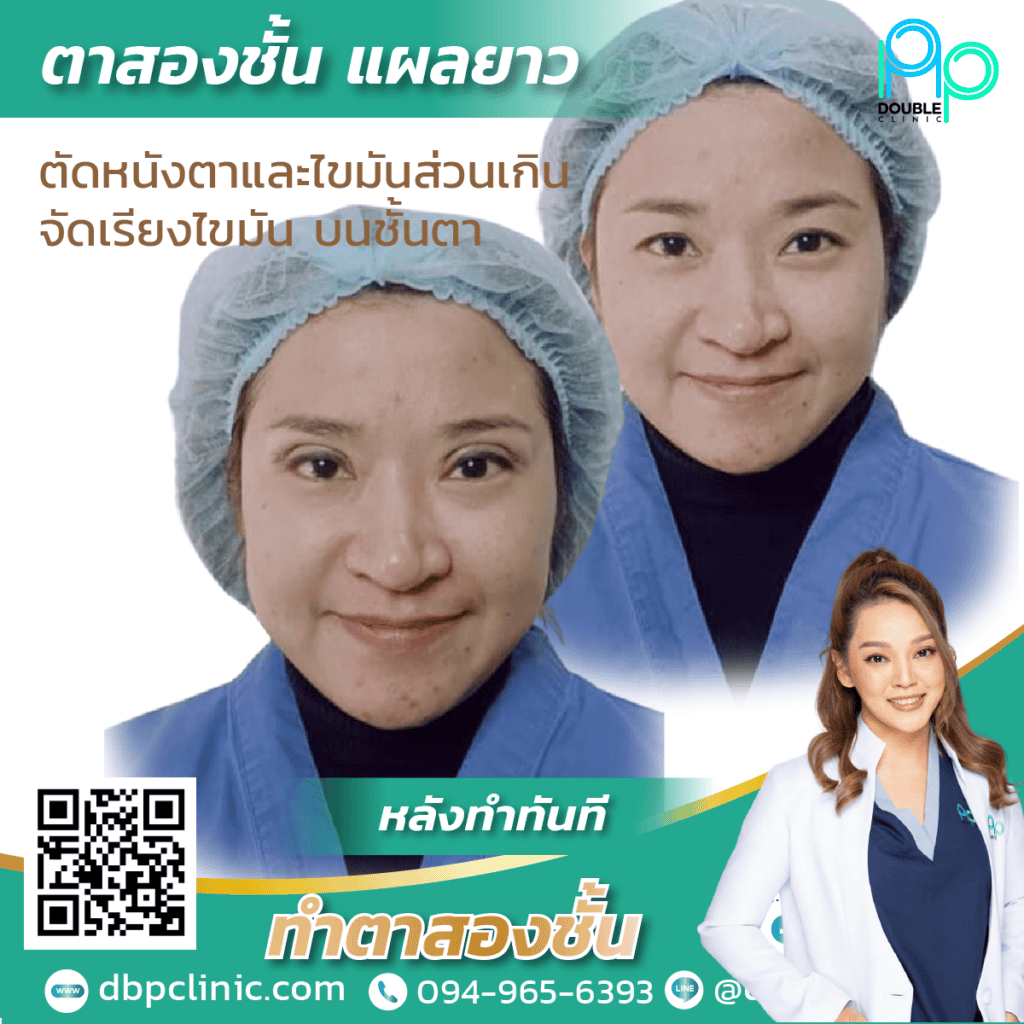 กล้ามเนื้อตาอ่อนแรง แก้ไขยังไง กล้ามเนื้อตาอ่อนแรง แก้ไขยังไง