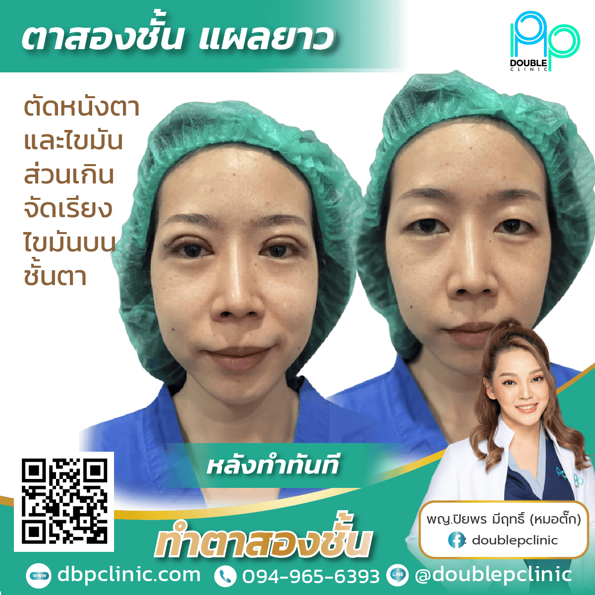 กล้ามเนื้อตาอ่อนแรง แก้ไขยังไง กล้ามเนื้อตาอ่อนแรง แก้ไขยังไง