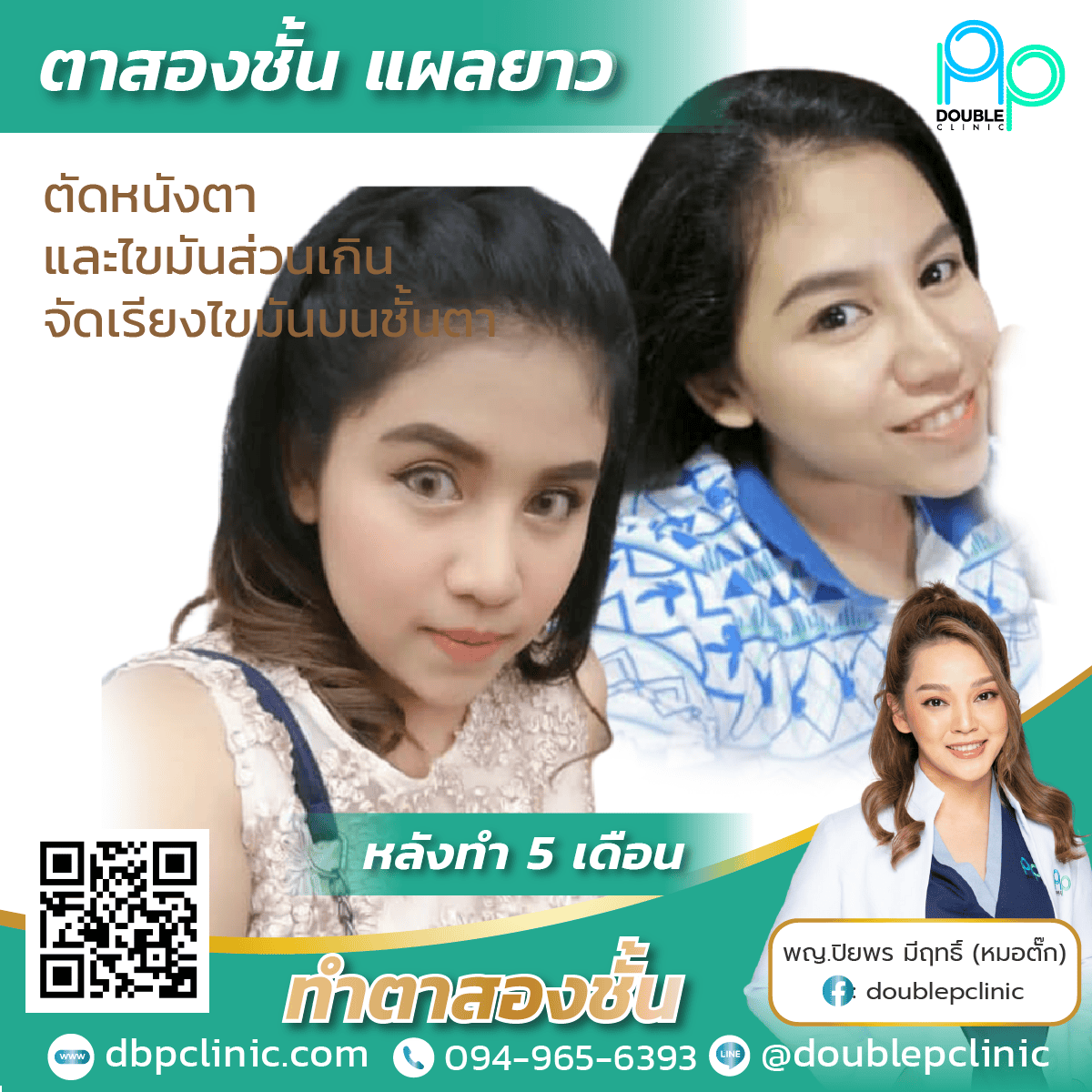 กล้ามเนื้อตาอ่อนแรง แก้ไขยังไง กล้ามเนื้อตาอ่อนแรง แก้ไขยังไง