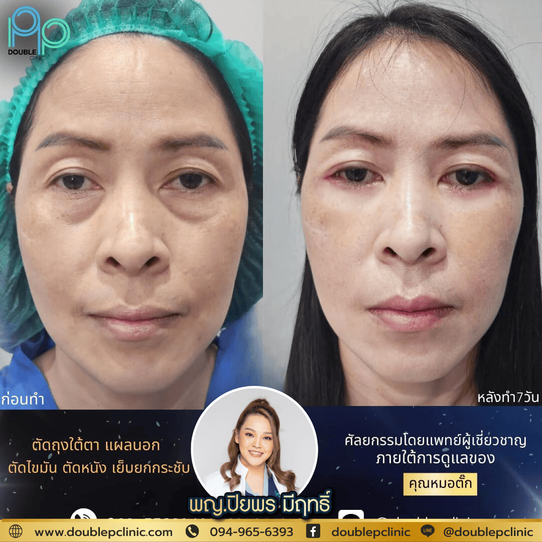 ตัดไขมันใต้ตา ราคา