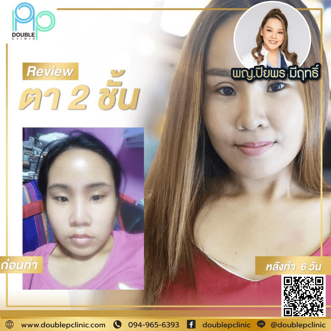 การดูแลหลังตัดไหม ตาสองชั้น การดูแลหลังตัดไหม ตาสองชั้น