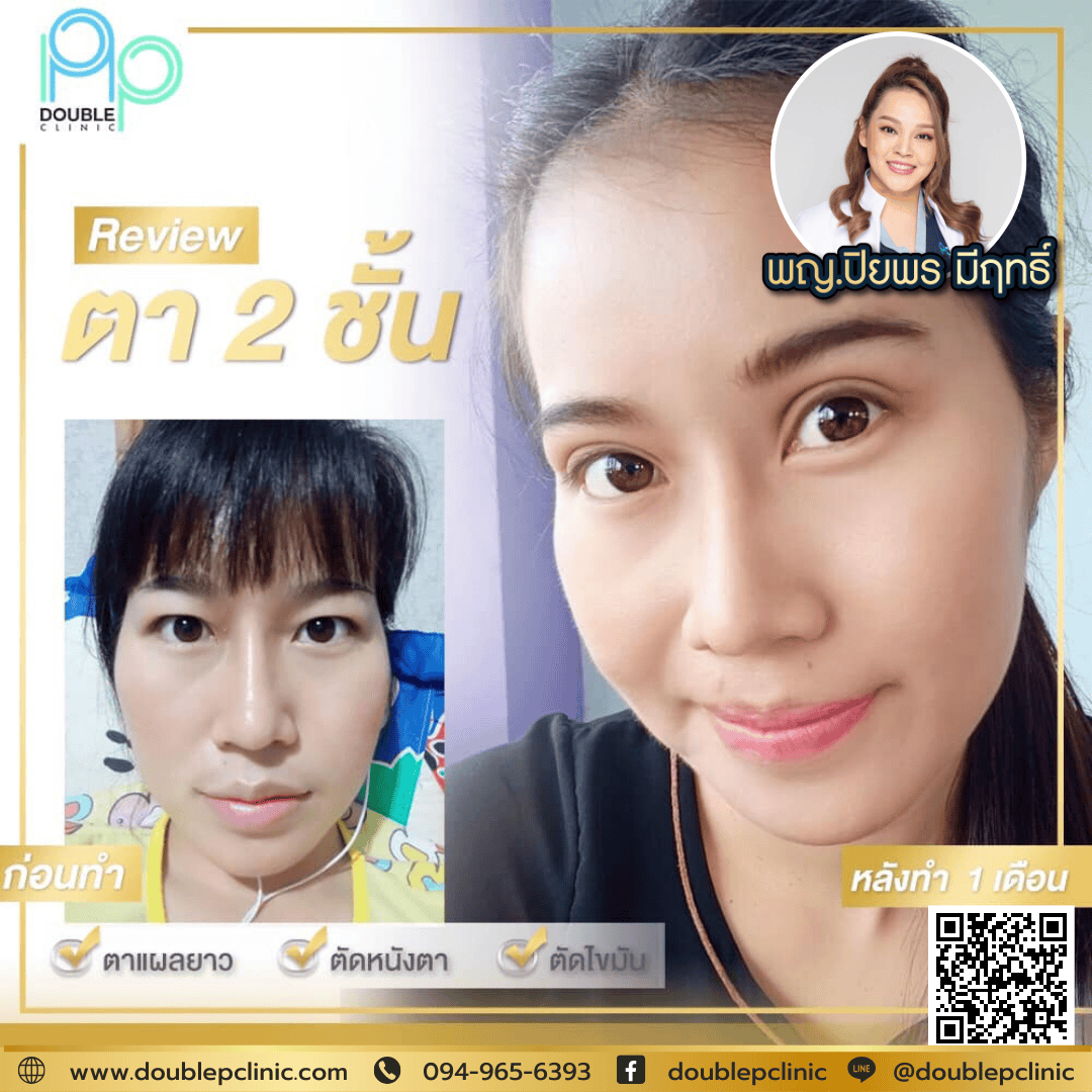ภาวะ กล้ามเนื้อตาอ่อนแรง ภาวะ กล้ามเนื้อตาอ่อนแรง