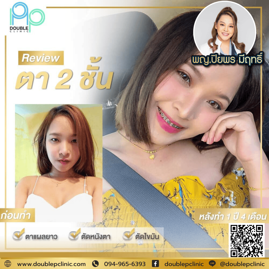 ภาวะ กล้ามเนื้อตาอ่อนแรง ภาวะ กล้ามเนื้อตาอ่อนแรง