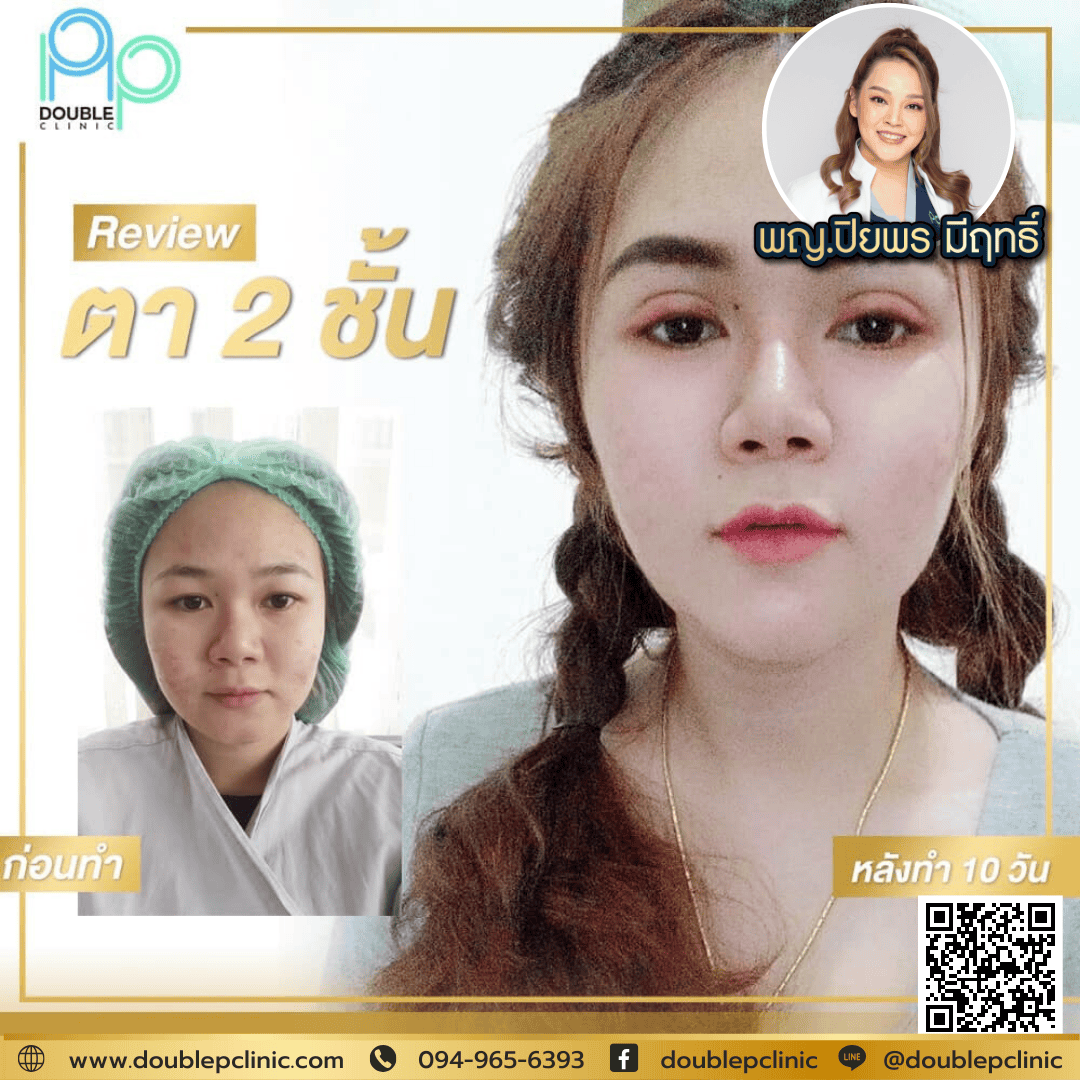 ศัลยกรรมแก้ไขหนังตาตก ศัลยกรรมแก้ไขหนังตาตก