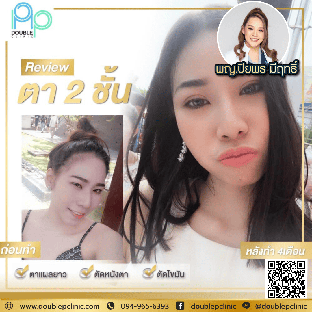 ทำตาสองชั้นกรีดยาว แก้กล้ามเนื้อตาอ่อนแรง ทำตาสองชั้นกรีดยาว แก้กล้ามเนื้อตาอ่อนแรง