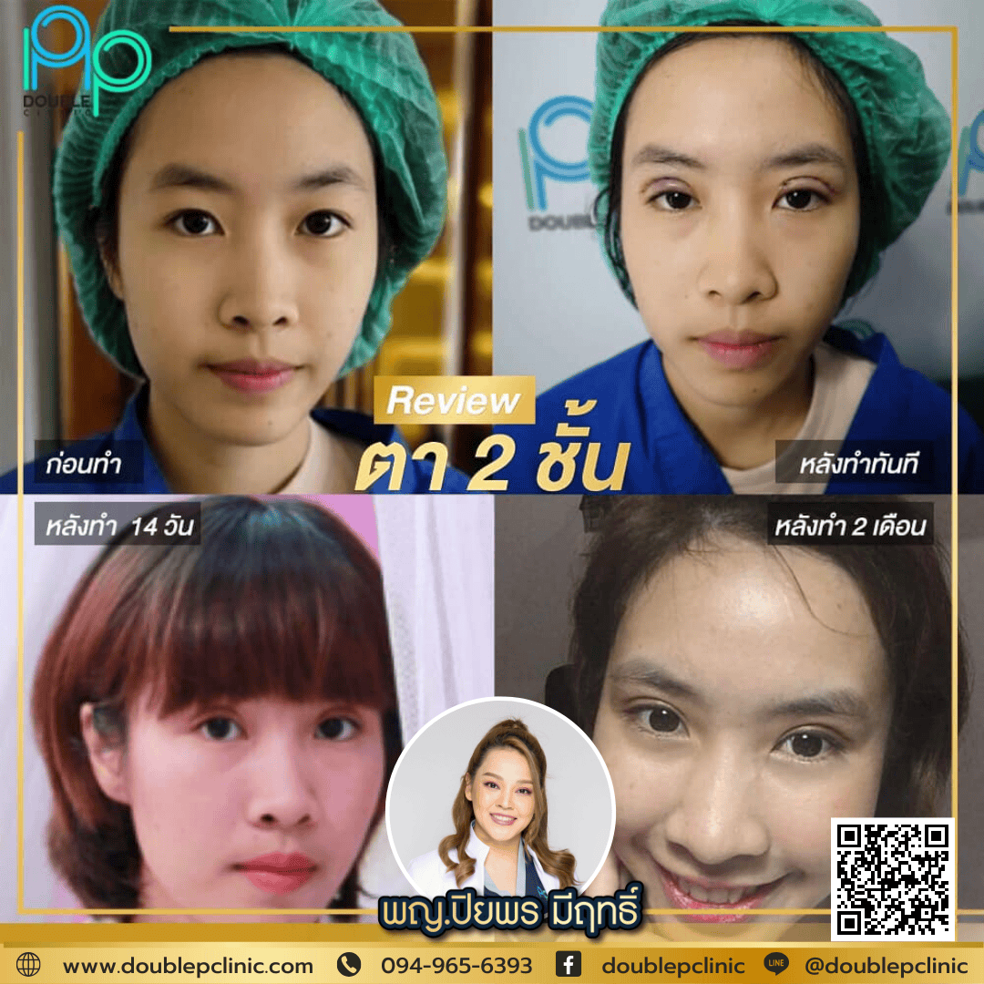 ตาขี้เกียจ แก้ไขด้วยทำตาสองชั้น ตาขี้เกียจ แก้ไขด้วยทำตาสองชั้น