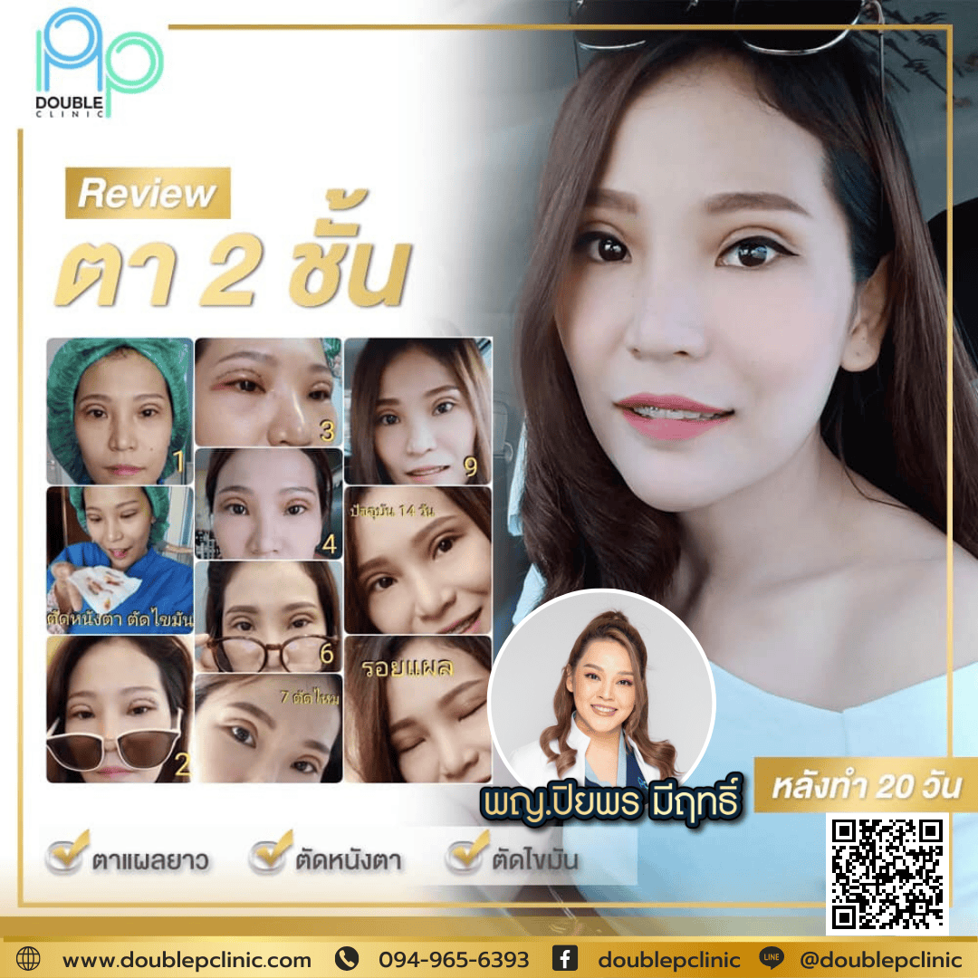 แก้ไขตาสองชั้น ที่ทำมาแล้ว แก้ไขตาสองชั้น ที่ทำมาแล้ว