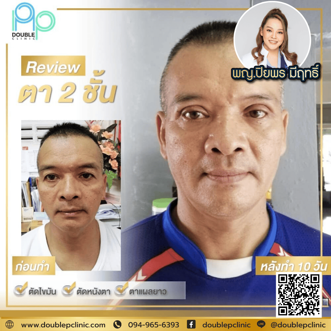 ทำตาสองชั้นหลบใน ผู้ชาย