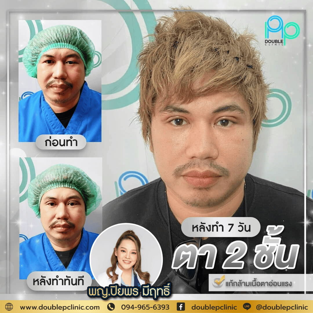 ทำตาสองชั้นหลบใน ผู้ชาย