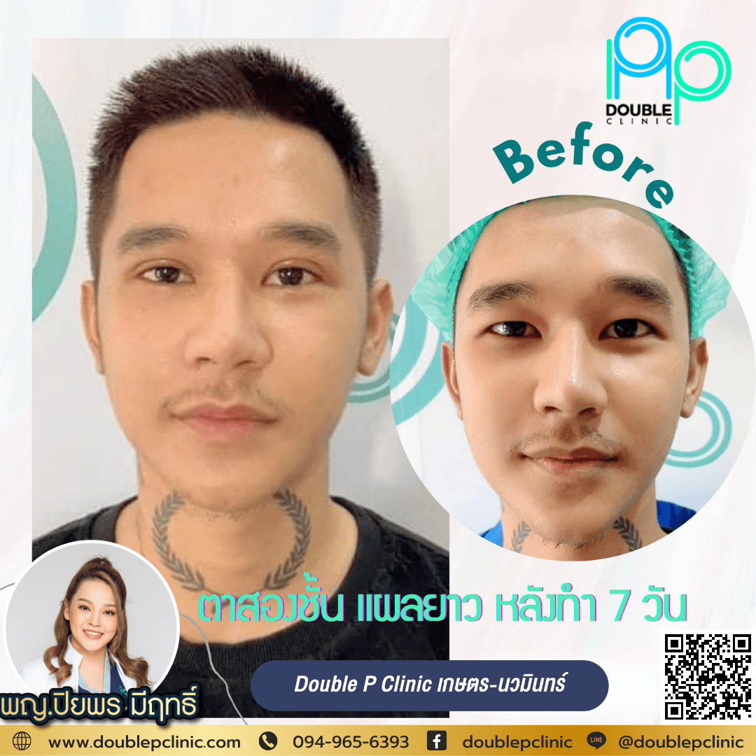ทำตาสองชั้นหลบใน ผู้ชาย