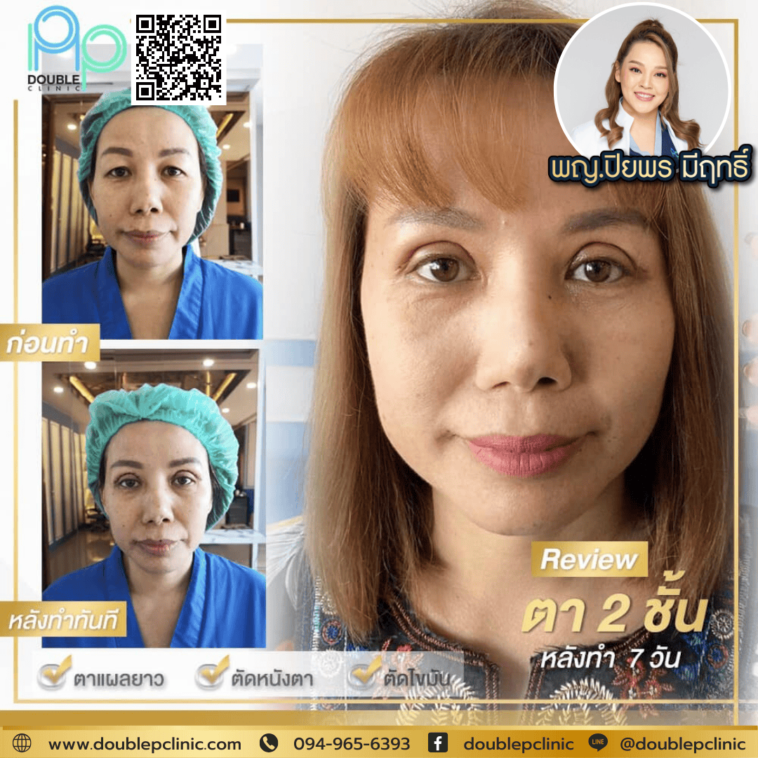ตาขี้เกียจ แก้ไขด้วยทำตาสองชั้น ตาขี้เกียจ แก้ไขด้วยทำตาสองชั้น