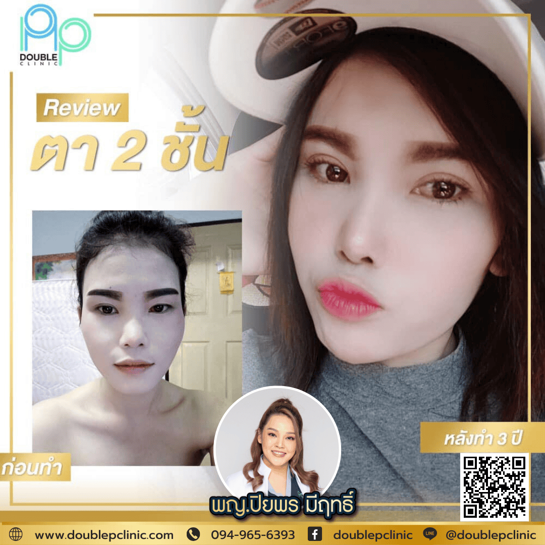 แก้ไขตาสองชั้น ที่ทํามาแล้ว แก้ไขตาสองชั้น ที่ทํามาแล้ว