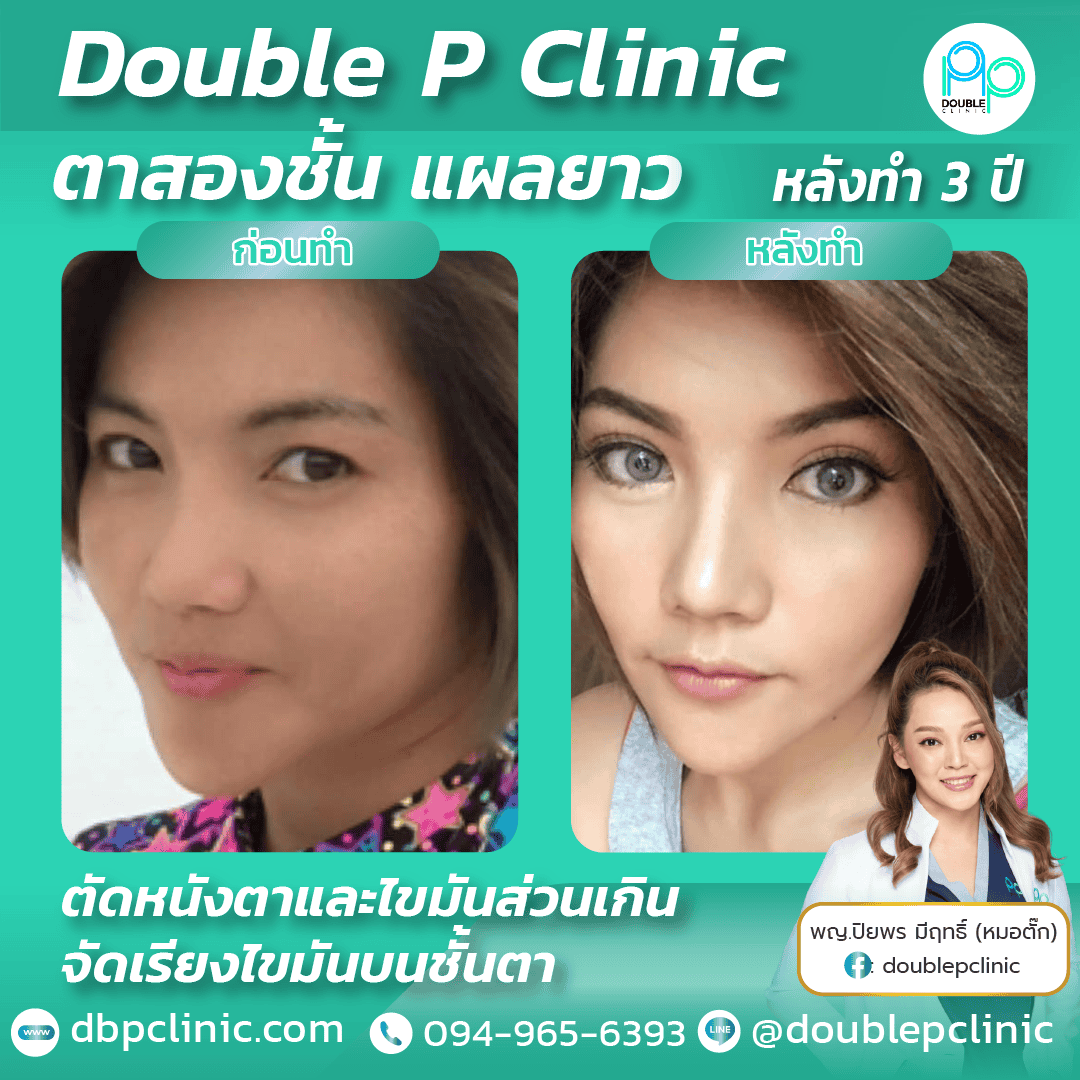 ทำตาสองชั้น หมอตั๊ก