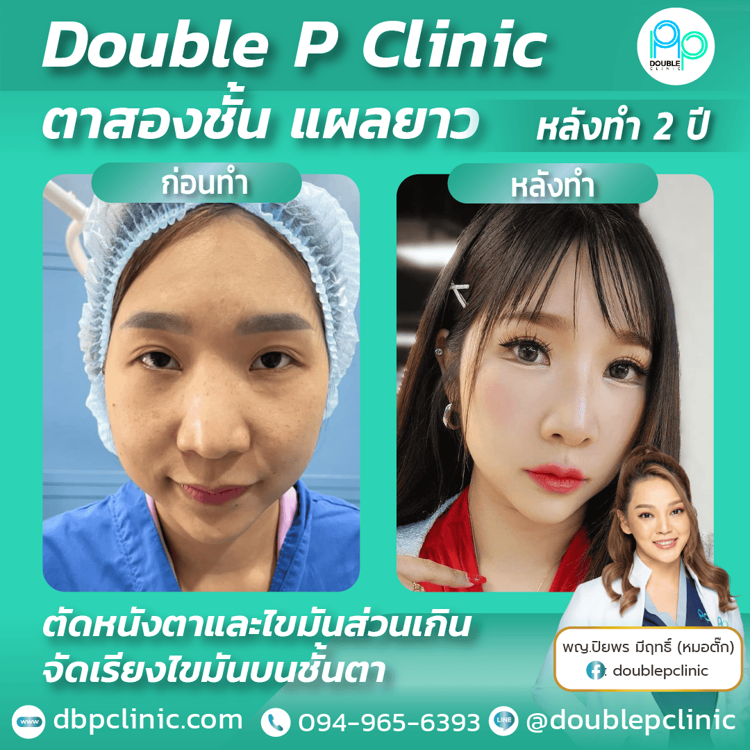 ทำตาสองชั้น พิษณุโลก