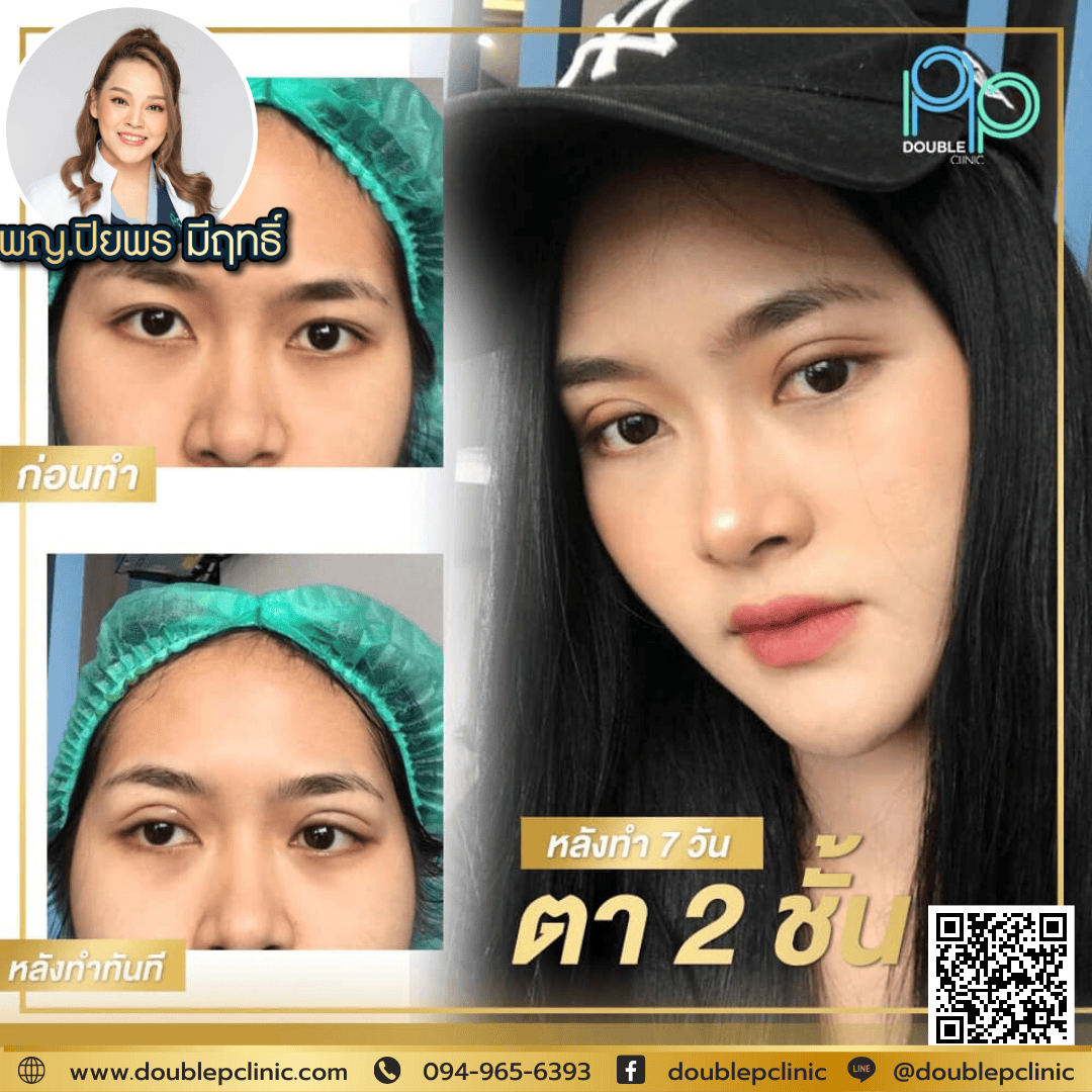 หนังตาตก หนังตาตก