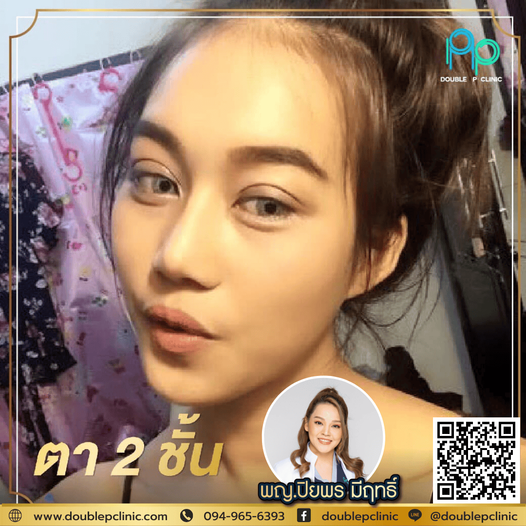 แก้ ตา 2 ชั้นให้เล็กลง