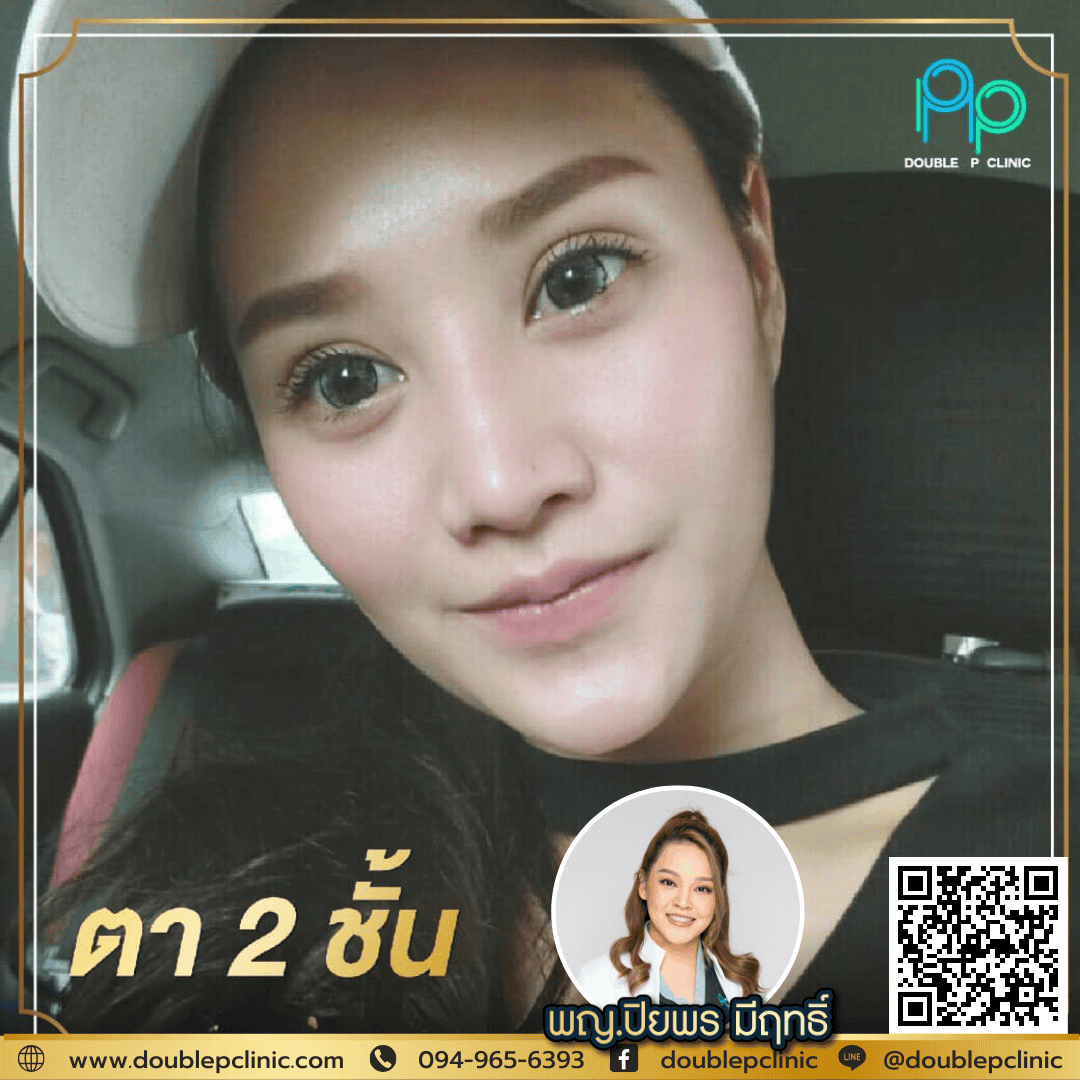 แก้ ตา 2 ชั้นให้เล็กลง