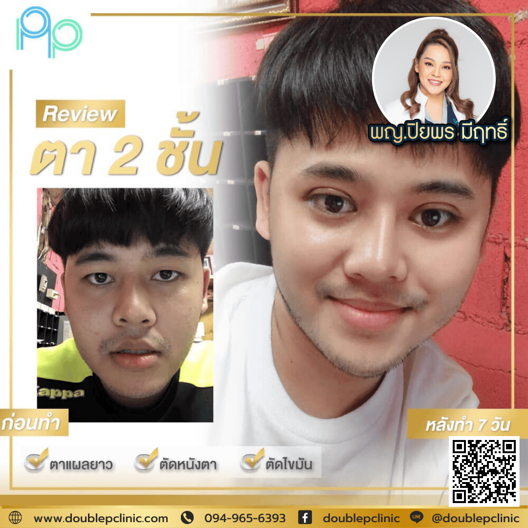 ทำตาสองชั้นหลบใน ผู้ชาย