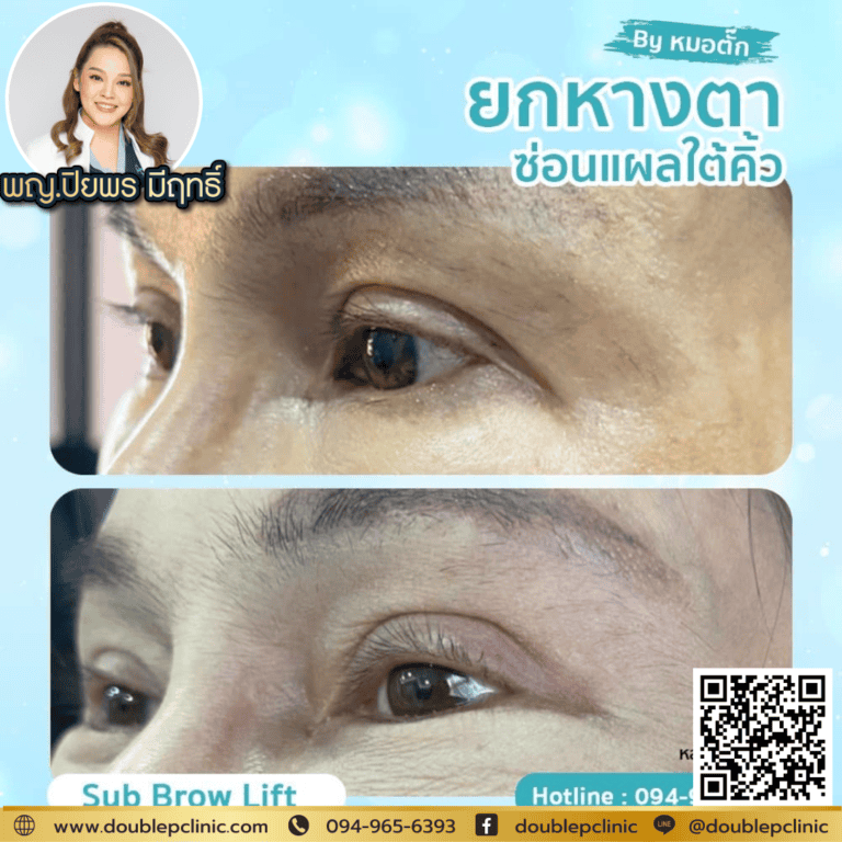ยกหางตามีแบบไหนบ้าง