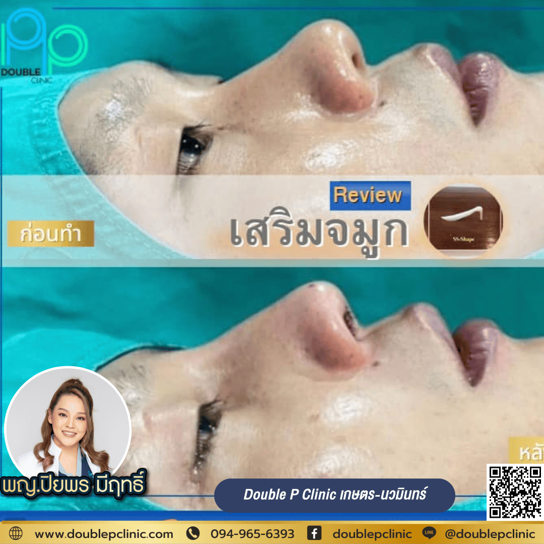 เสริมจมูก มีเทคนิคอะไรบ้าง