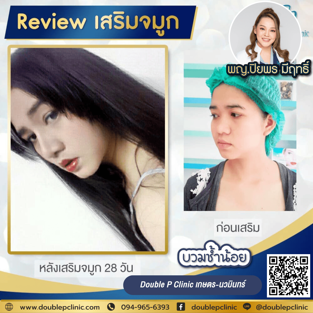 เสริมจมูก ราคาเท่าไหร่