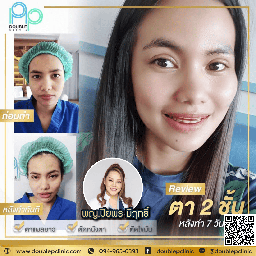ทำตาสองชั้น คลินิกเสริมความงาม พิษณุโลก