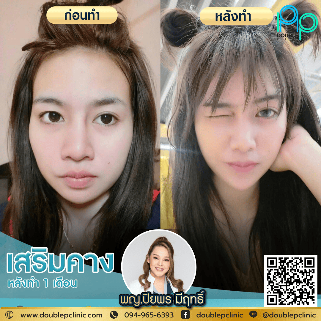 เสริมคาง พิษณุโลก