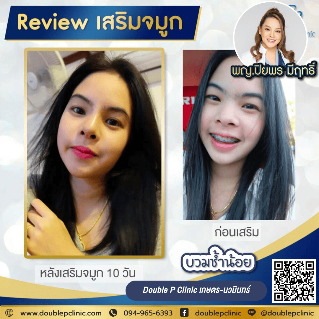 เสริมจมูก