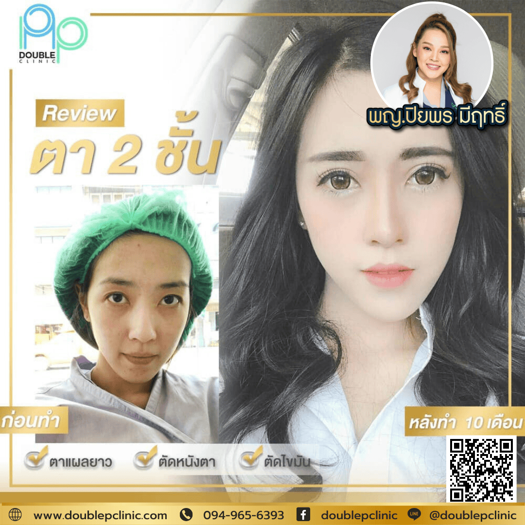 การทำศัลยกรรม ถุงใต้ตา แบบแผลใน