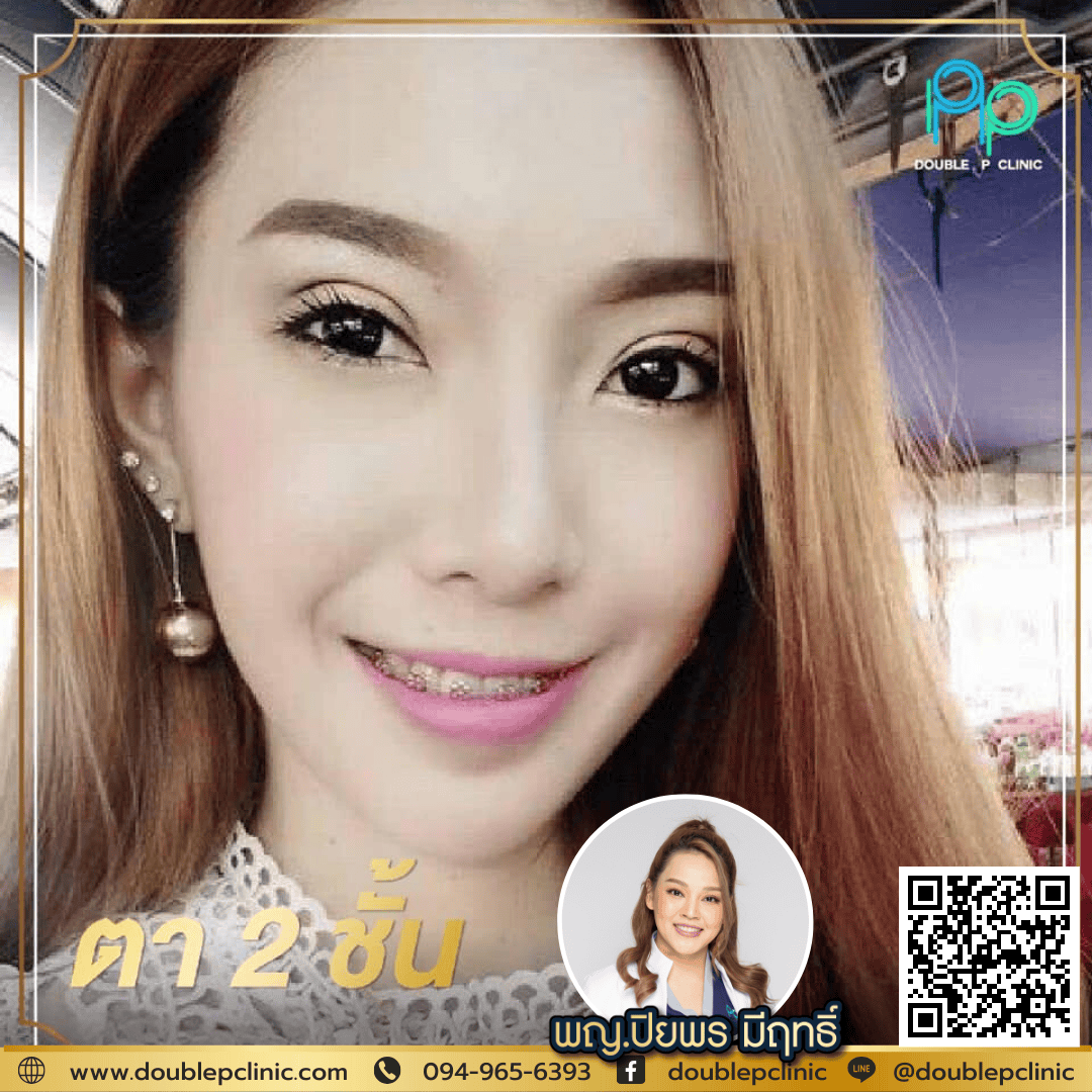 ทำตาสองชั้น กรีดยาว พิษณุโลก