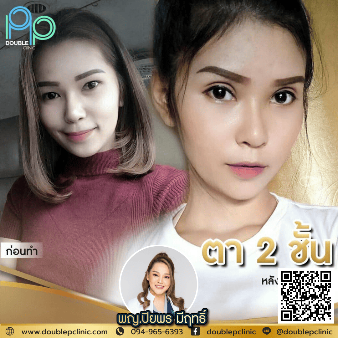 ทำตาสองชั้น กรีดยาว พิษณุโลก