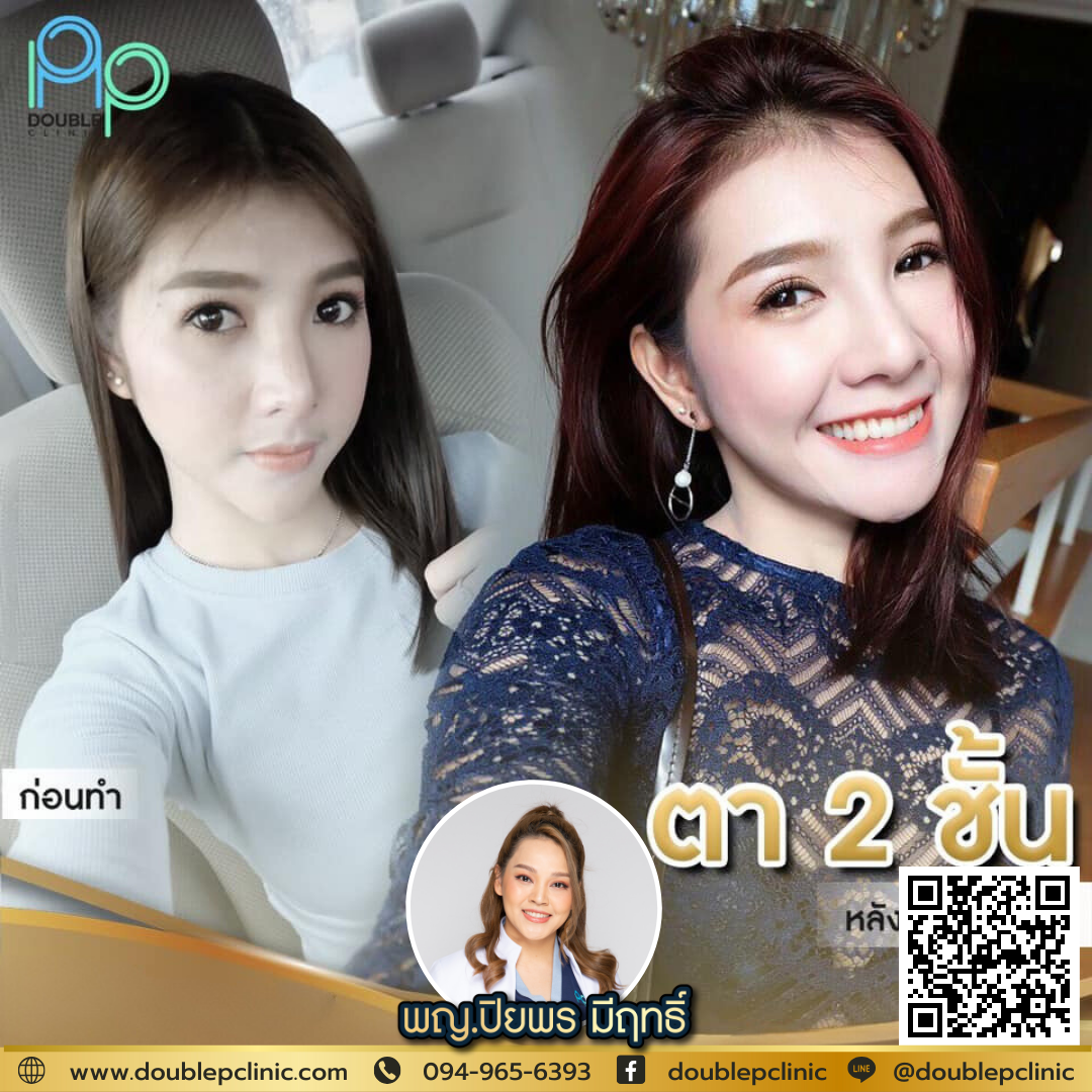 ตาสองชั้น เติมไขมัน 