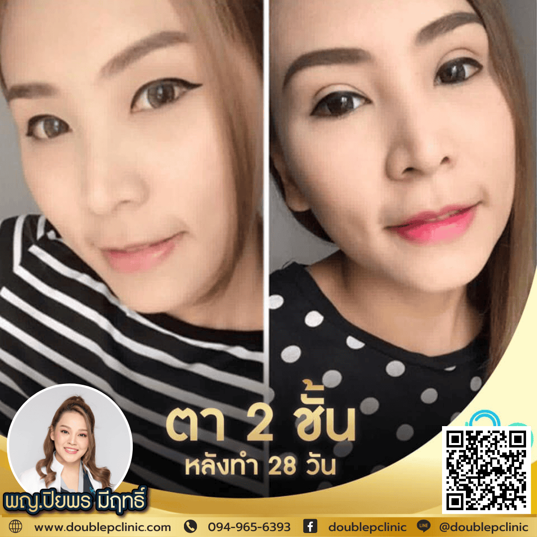 คลินิก แก้ไขกล้ามเนื้อตาอ่อนแรง พิษณุโลก