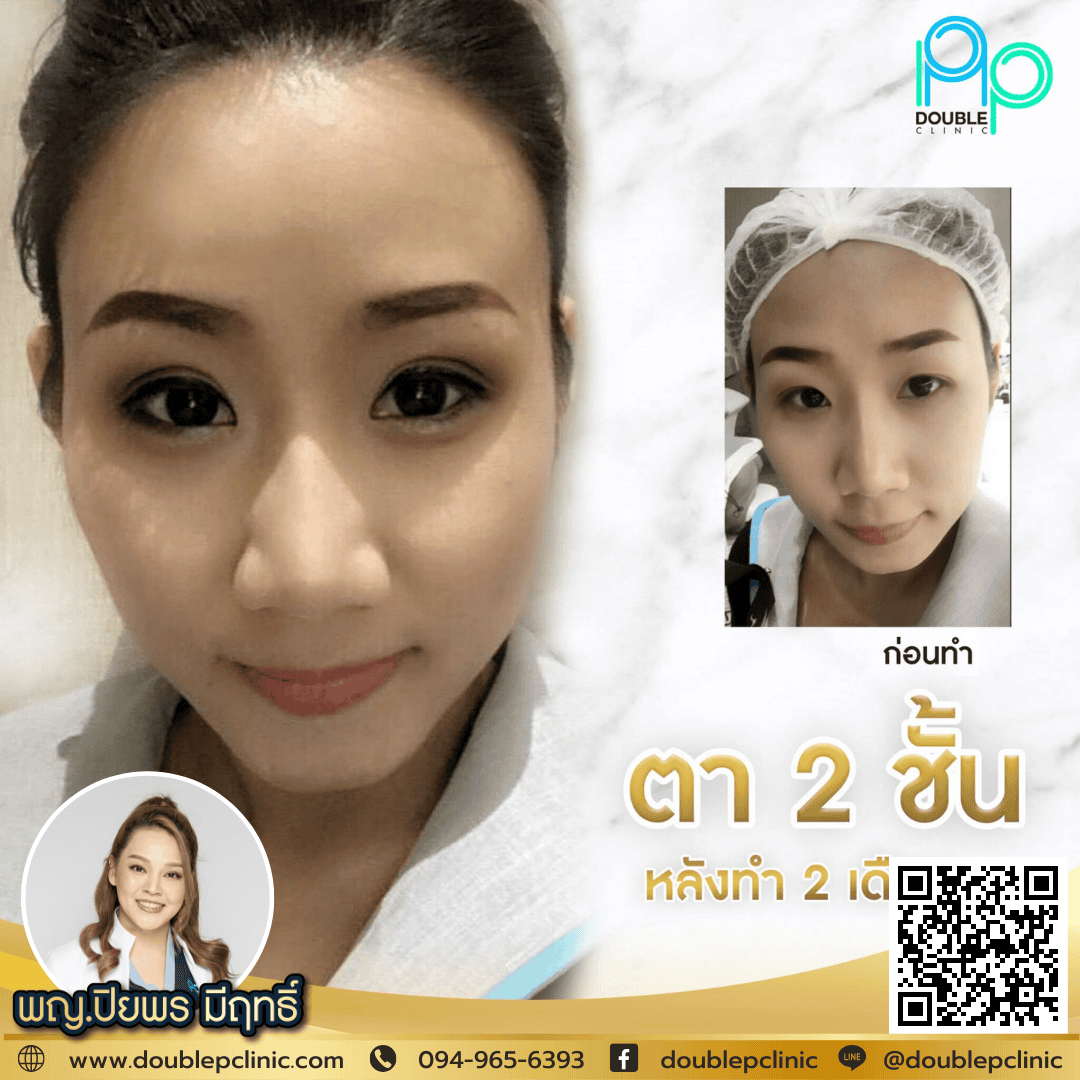 ตัดไขมันใต้ตา พิษณุโลก