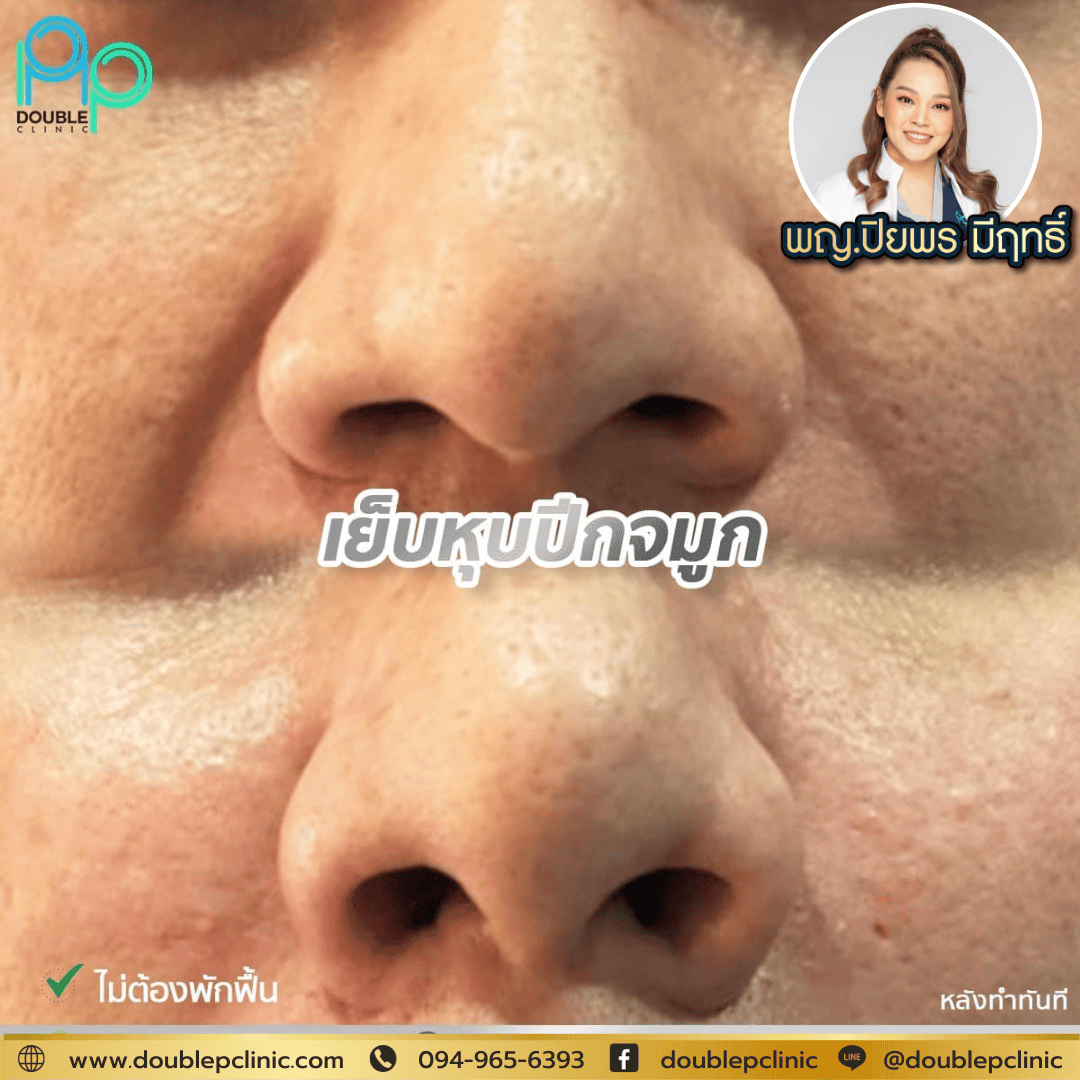 เย็บปีกจมูก พิษณุโลก
