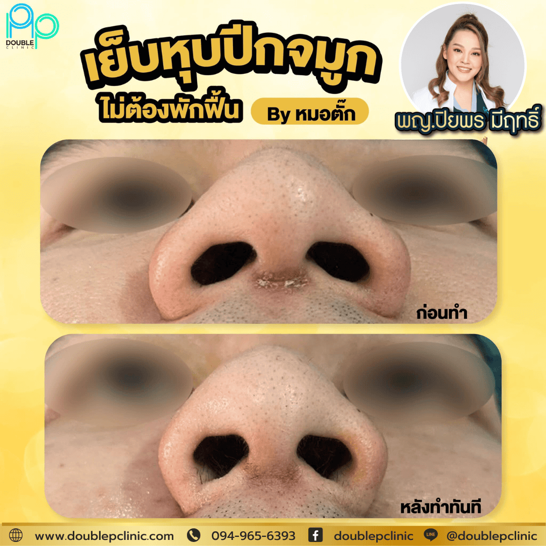 เย็บปีกจมูก พิษณุโลก
