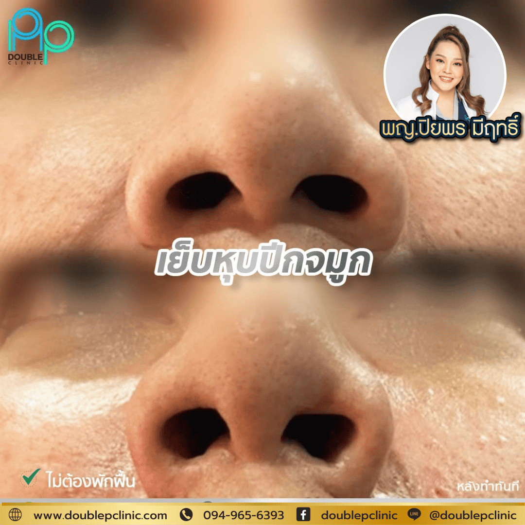 เย็บปีกจมูก พิษณุโลก