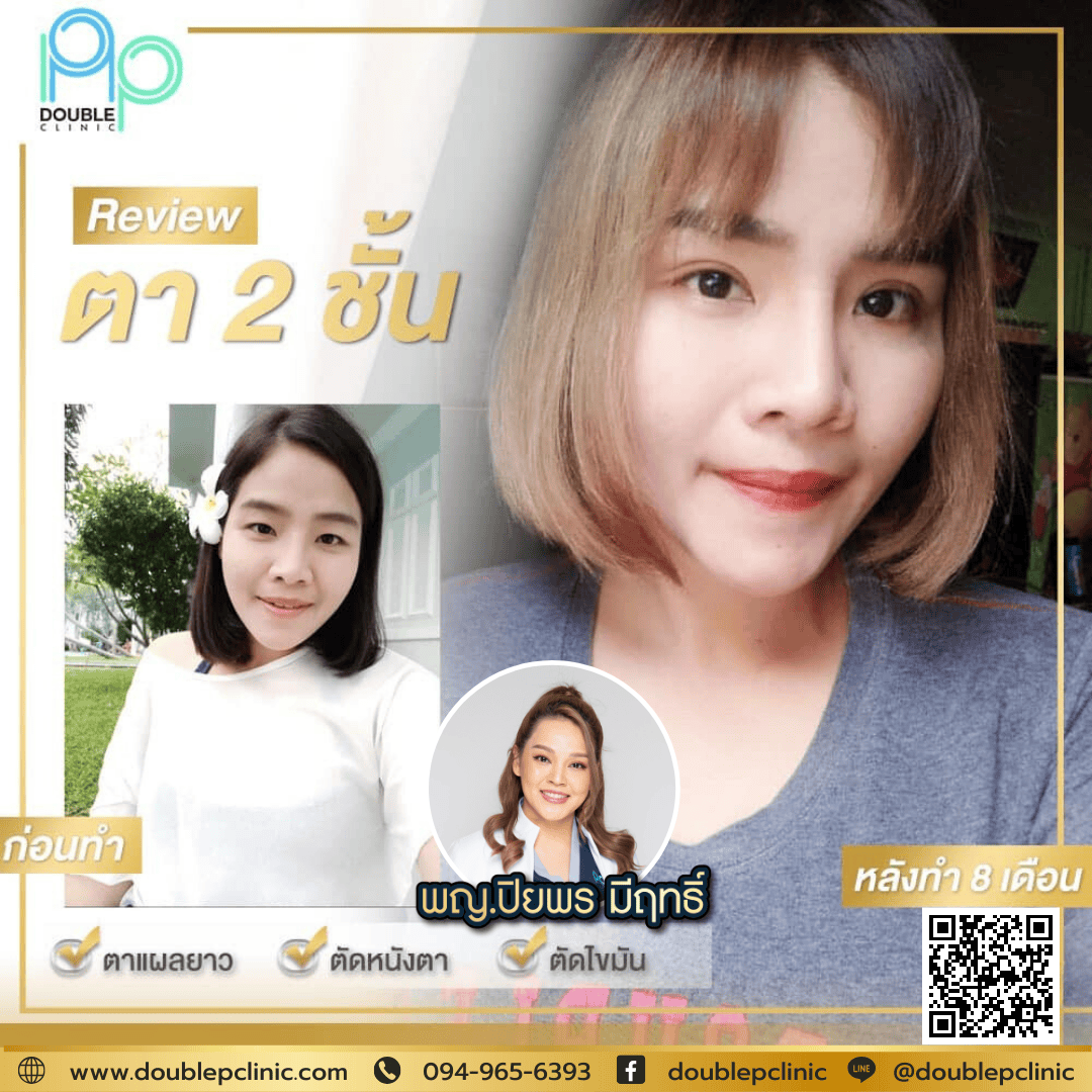 ขั้นตอนการผ่าตาสองชั้น 